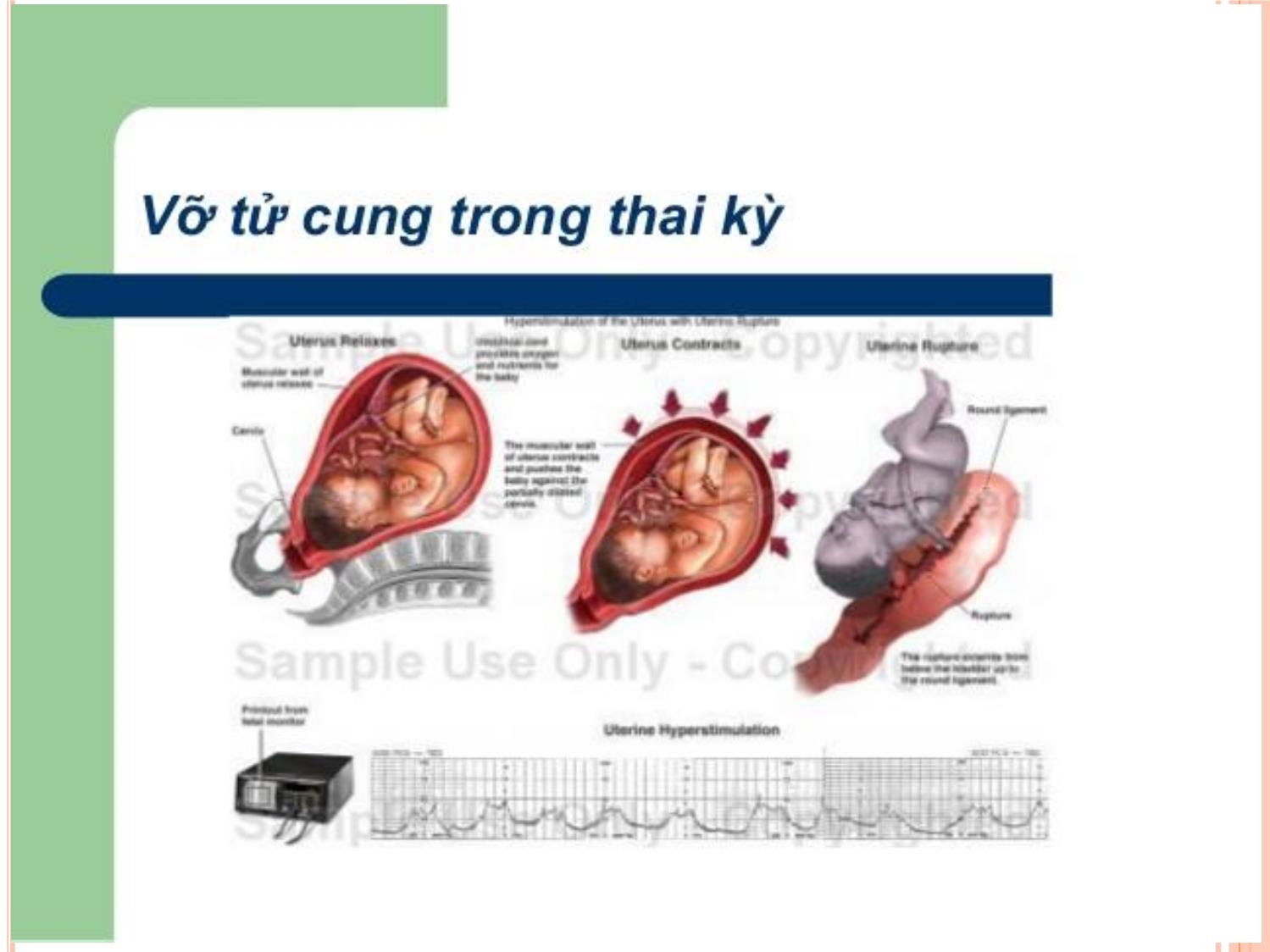 Bài giảng Dọa vỡ - Vỡ tử cung trang 4