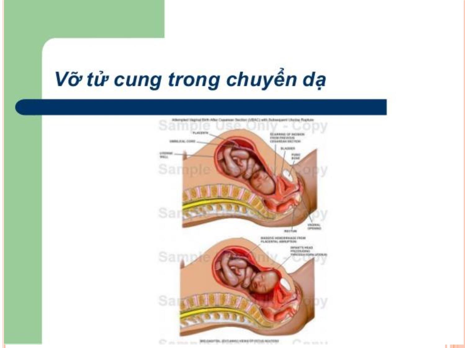 Bài giảng Dọa vỡ - Vỡ tử cung trang 5