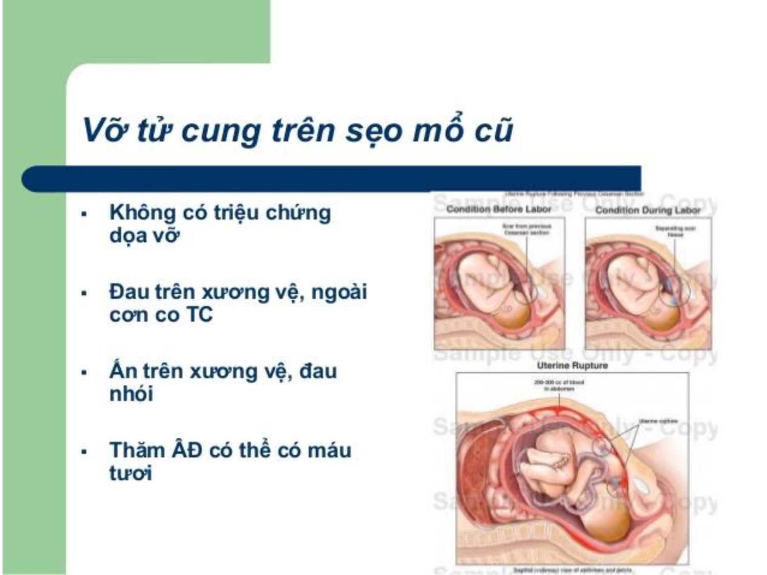 Bài giảng Dọa vỡ - Vỡ tử cung trang 6