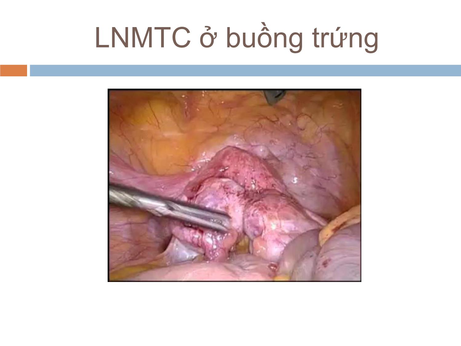 Bài giảng Lạc nội mạc tử cung vai trò của phẫu thuật trang 8