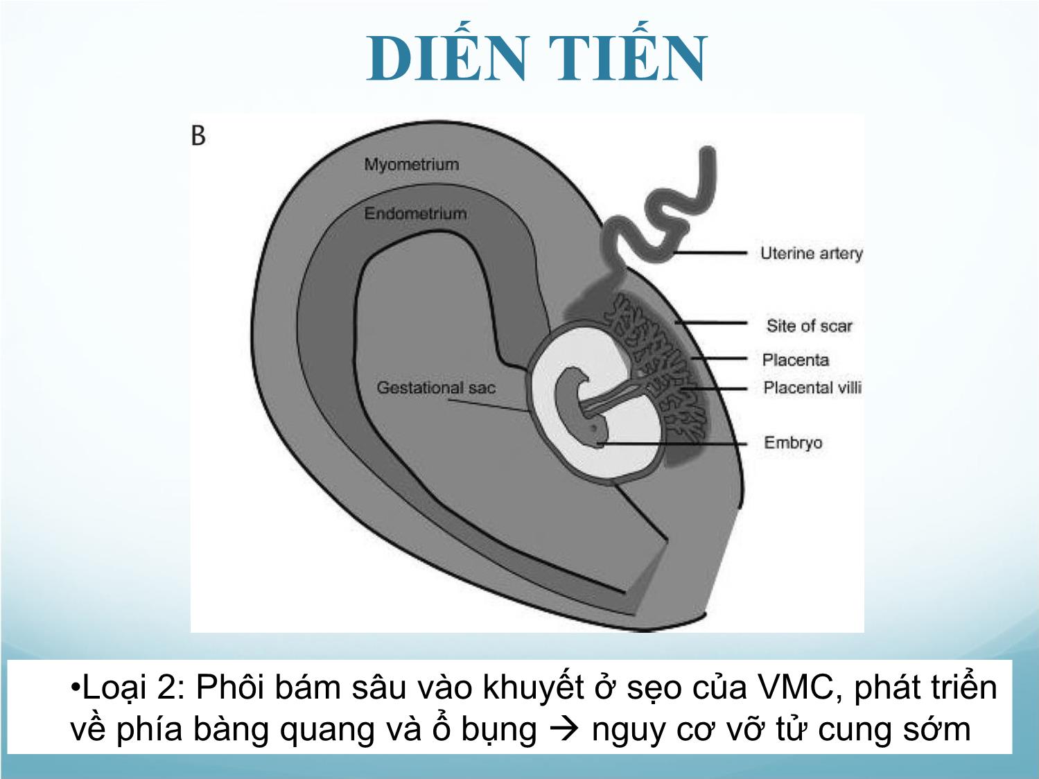 Bài giảng Thai bám ở sẹo mổ lấy thai trang 9