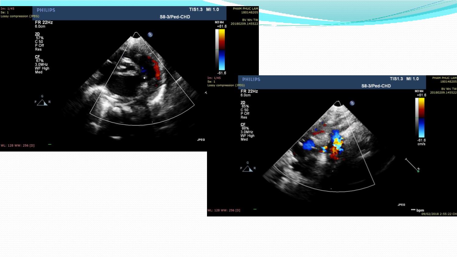 Bài giảng Đánh giá kết quả phẫu thuật thắt ống động mạch ở trẻ sơ sinh còn ống động mạch lớn trang 8