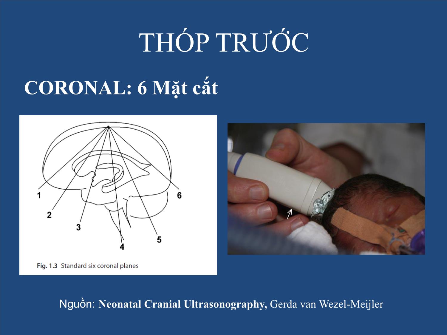 Bài giảng Neonatal Brain US trang 7