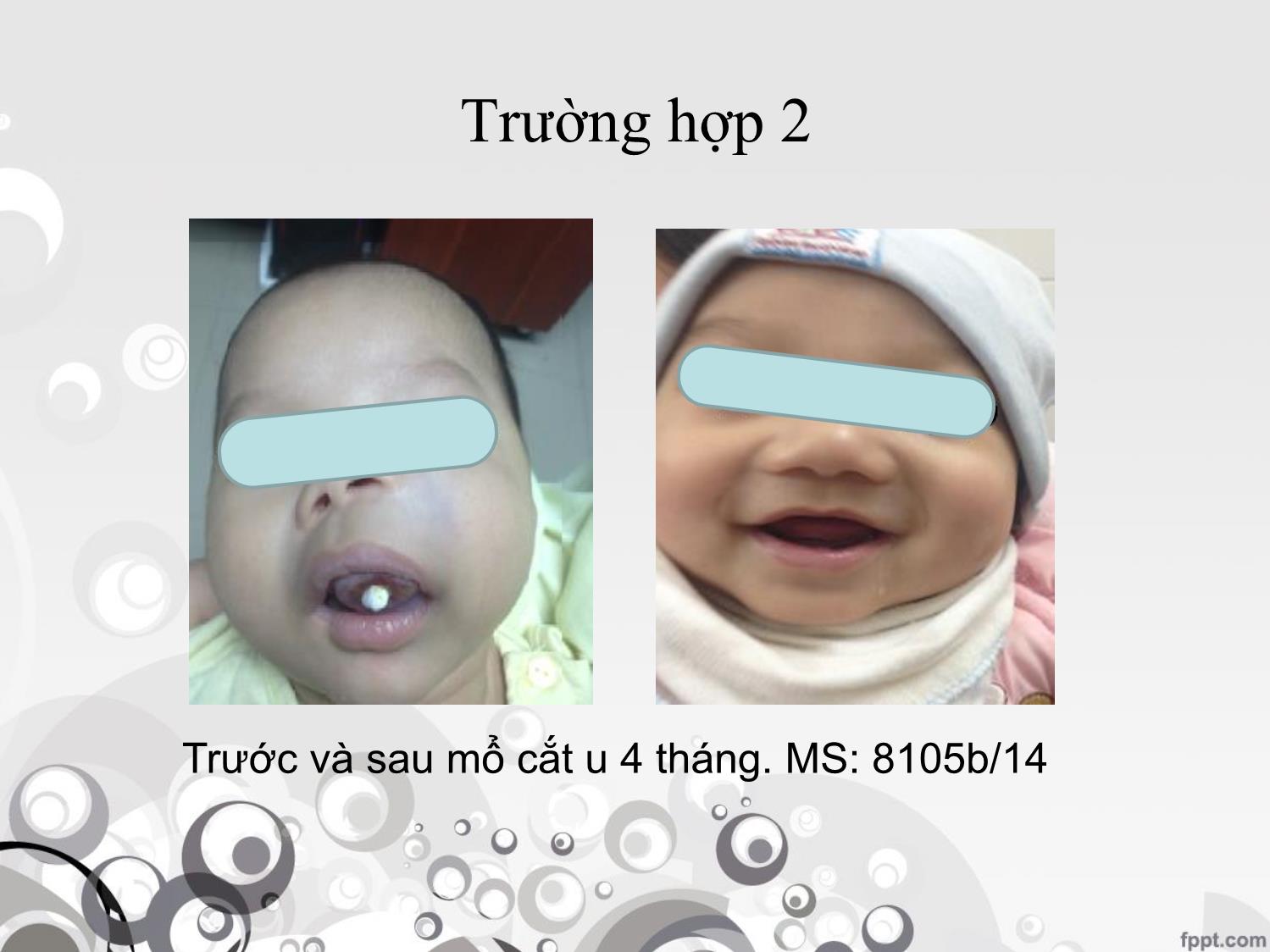 Bài giảng U ngoại bì thần kinh hắc tố ở trẻ em trang 10