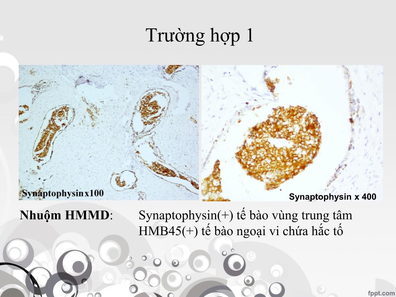 Bài giảng U ngoại bì thần kinh hắc tố ở trẻ em trang 7