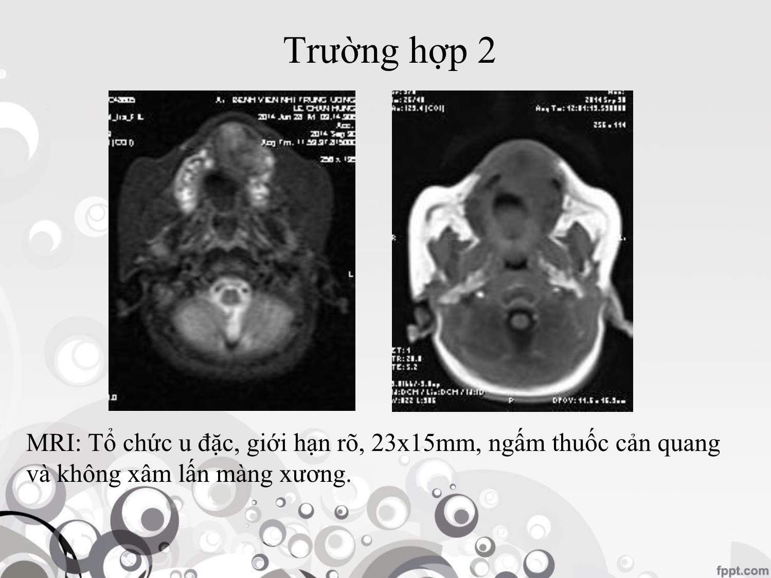 Bài giảng U ngoại bì thần kinh hắc tố ở trẻ em trang 9