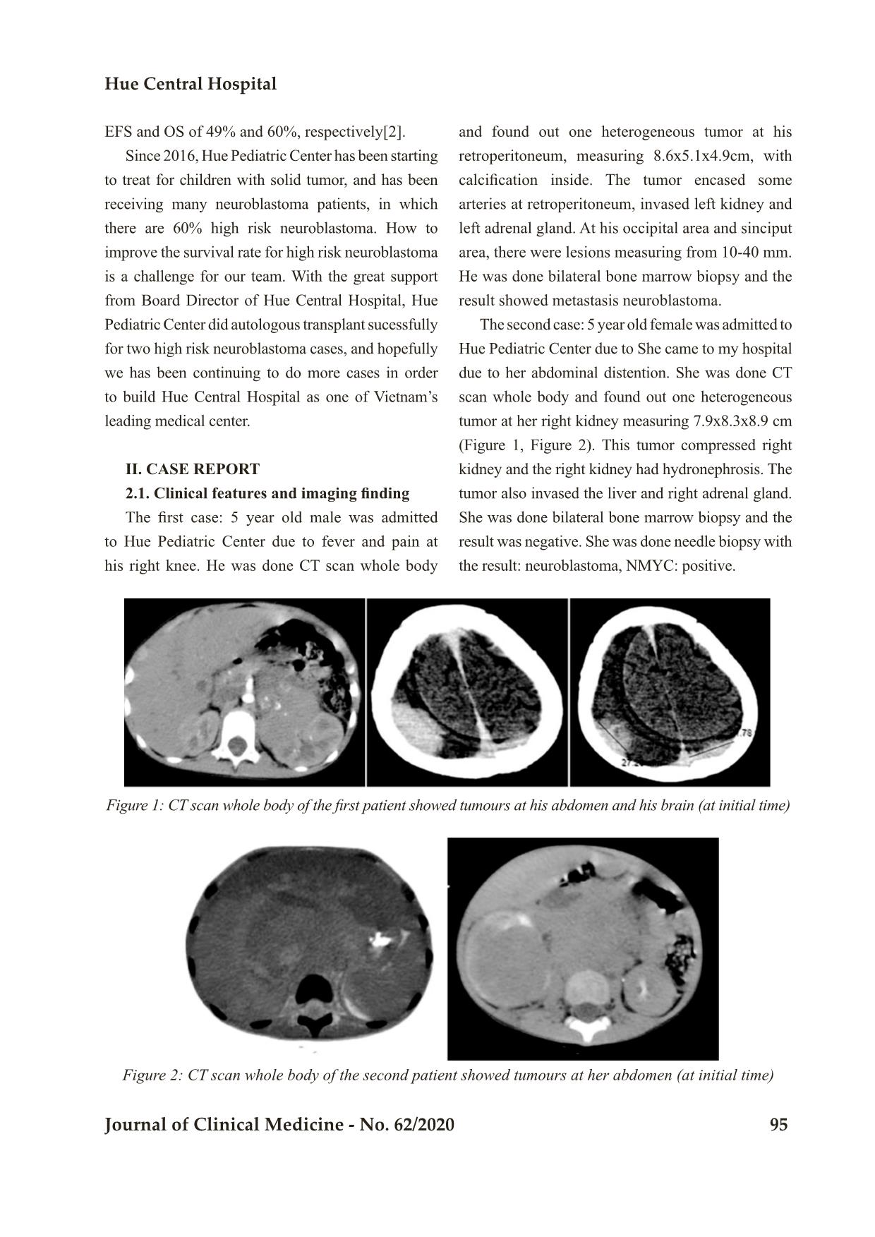 High dose chemotherapy and autologous hematopoietic stem cell rescue for children with high risk neuroblastoma: Two case report trang 2