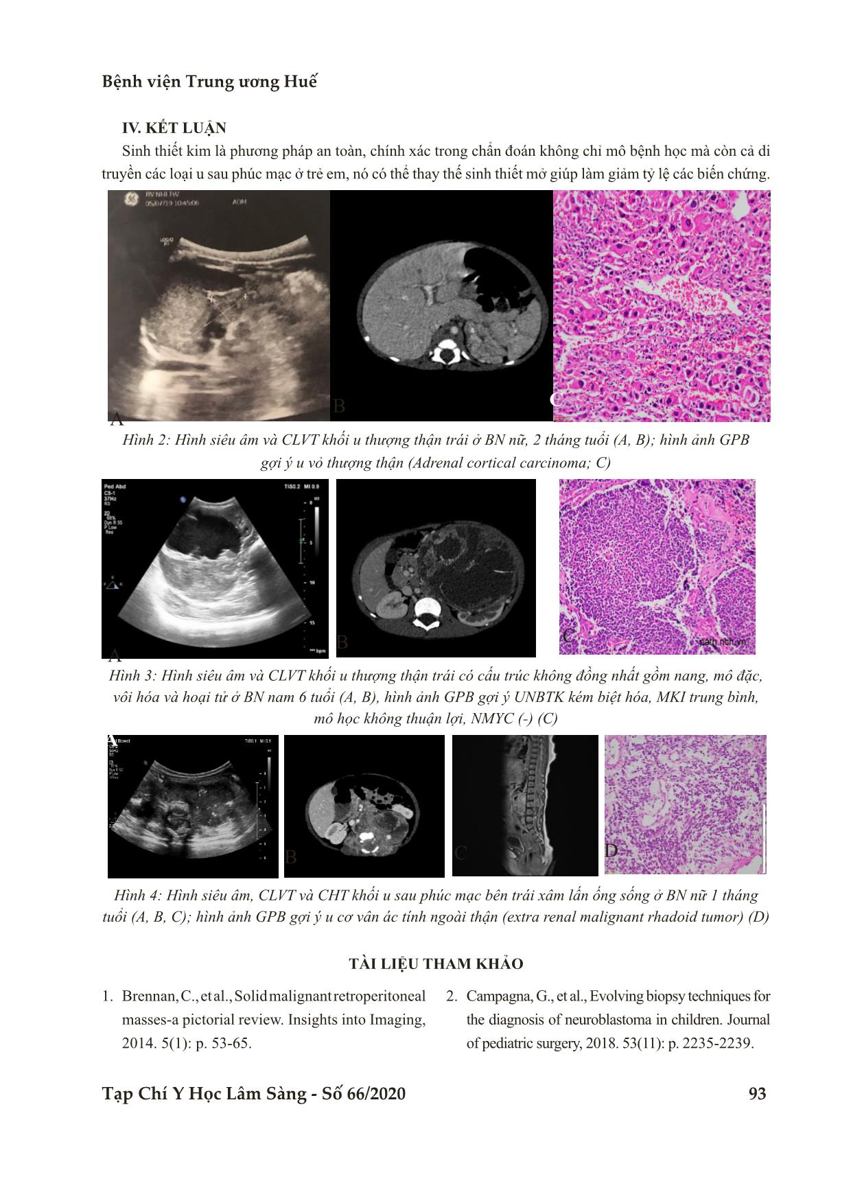 Sinh thiết kim dưới hướng dẫn của siêu âm chẩn đoán u sau phúc mạc ở trẻ em: Hồi cứu trên 52 bệnh nhân trang 6